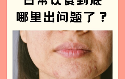 下巴长痘痘是什么原因引起的(下巴长痘痘是什么原因引起的女性)