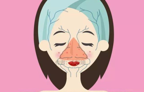 三角区长痘痘是什么原因(女性三角区长痘痘是什么原因)