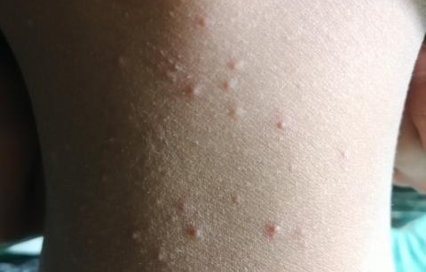 脖子上长了很多小痘痘(脖子上长了很多小痘痘是什么原因)