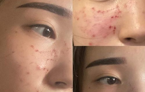 皮秒和激光哪个祛斑效果好(皮秒和激光哪个祛斑效果好一点)