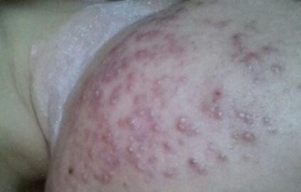 内分泌失调长痘痘怎么调理(内分泌失调脸上长痘痘了吃什么药)