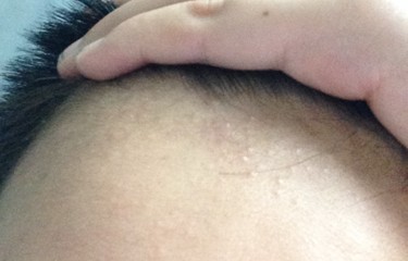 耳垂肉里长了痘痘一样的硬粒(耳垂里面长了个硬疙瘩一捏就疼)