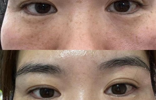 皮秒激光祛斑(皮秒激光祛斑的危害)