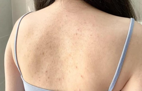 后背长痘痘(后背长痘痘是什么原因引起的)