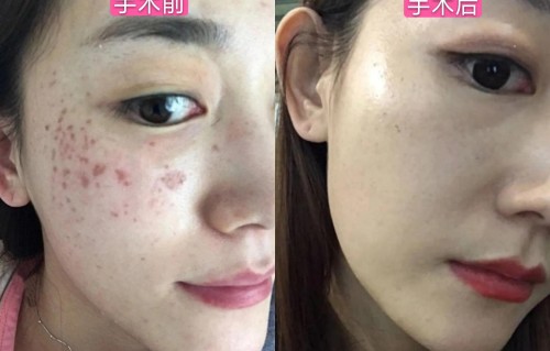 祛斑手术(祛斑手术费用大概多少钱)
