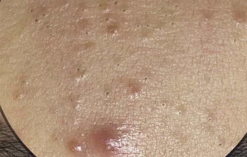 痘痘挤出血算干净了吗(痘痘 挤出血)