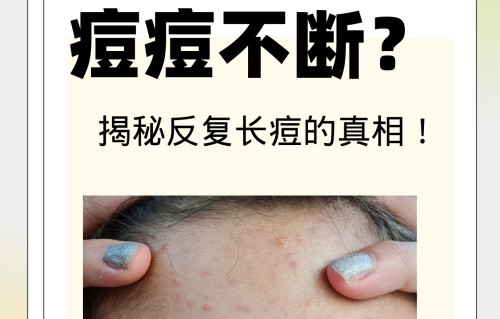 脑门长痘痘是什么原因(脑门和脸颊长痘的原因)