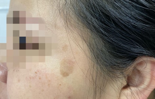 激光祛老年斑(激光祛老年斑的一般价格)