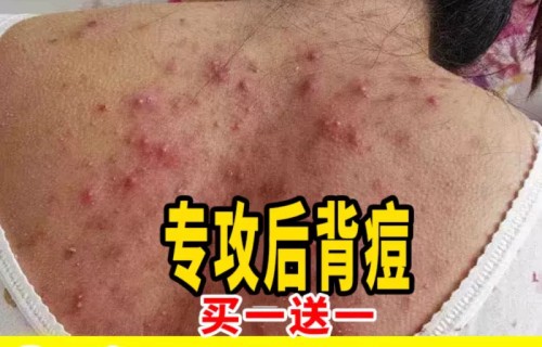 背上长痘痘擦什么药膏(后背长痘痘怎么消除最快最有效)