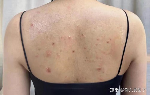 背上长痘痘(背上长痘痘怎么消除最快方法)