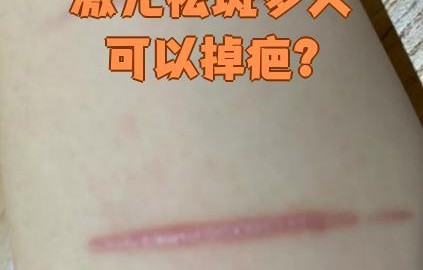 激光祛斑会留疤吗(激光祛斑会不会留疤或者有坑)