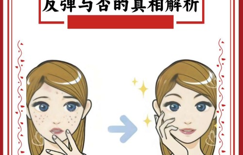 激光祛斑会反弹吗(激光祛斑好吗 激光祛斑会反弹吗)
