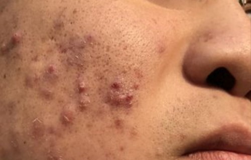 脸上起痘痘(脸上起痘痘去医院挂什么科)