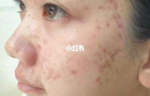 痘痘肌(痘痘肌吃什么食物清单)