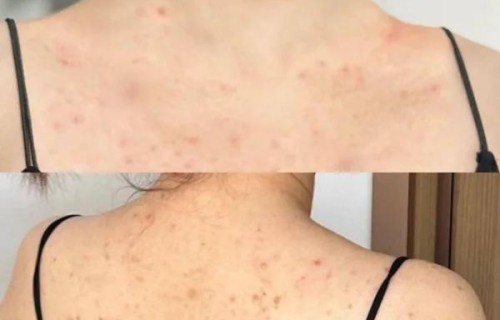 后背长痘痘是螨虫吗(后背长痘痘是螨虫吗图片)