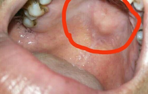 喉咙里一粒一粒像痘痘一样(喉咙里一粒一粒像痘痘一样怎么消除)