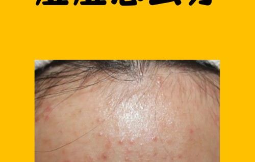 头皮长痘痘是什么原因(头发里头皮长痘痘是什么原因)