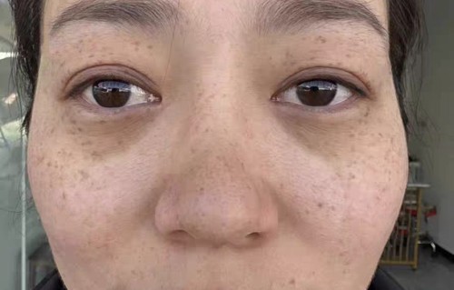 皮肤美白祛斑(皮肤美白祛斑霜有用吗)