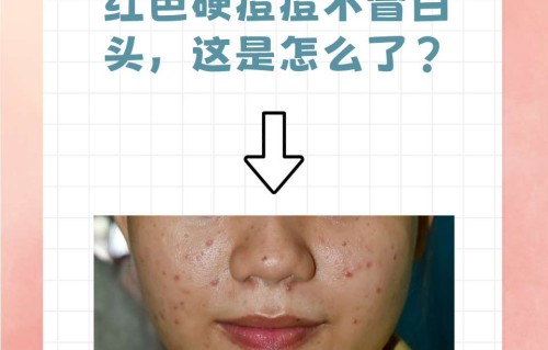 无脓头很大很硬的痘痘(无脓头很大很硬的痘痘可以用红霉素吗)