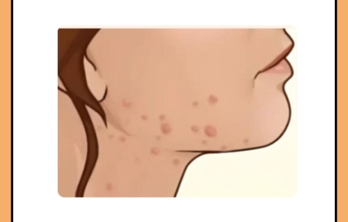 熬夜会长痘痘吗(熬夜会长痘痘吗?女生)