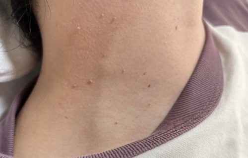 脖子上长痘痘是什么原因(后背脖子上长痘痘是什么原因)