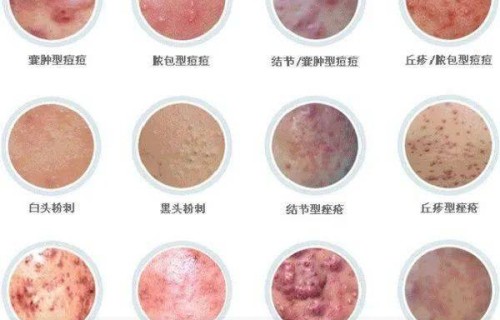 外阴上长了个痘痘(女士阴外部长痘痘)