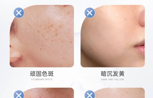 十大美白祛斑排行榜(十大美白祛斑排行榜求推荐)