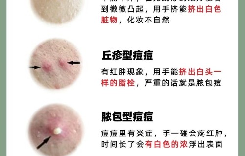丘疹型痘痘怎么治疗(hpv感染红疹子图片)