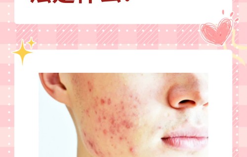 治痘痘(治痘痘什么药最快最好的方法)