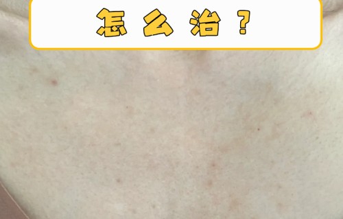 女生背上和胸前长痘痘怎么办(女生背上胸上长痘痘的原因)