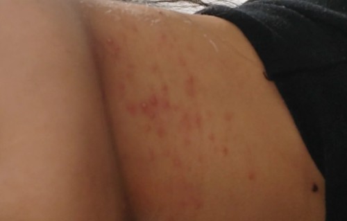 脖子长痘痘是怎么回事(后面脖子长痘痘是怎么回事)