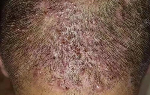 头皮上长痘痘(头皮上长痘痘和脓包用什么药膏)