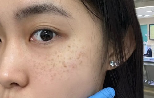 怎样祛斑(怎样祛斑淡斑效果最好)