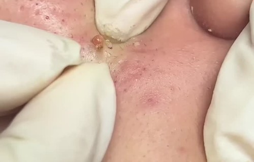 挤痘痘视频(挤痘痘视频最新)