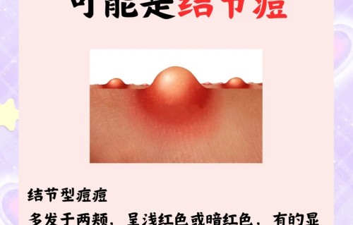 下颚长痘痘的原因(下颚线两侧长痘痘是什么原因)