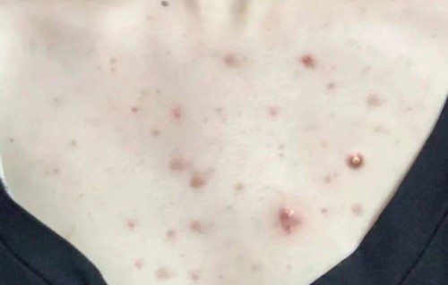 前胸后背长痘痘是什么原因(男孩子前胸后背长痘痘是什么原因)