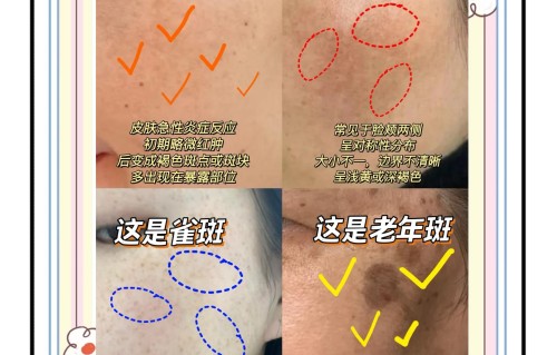 医院可以祛斑吗(医院可以祛斑吗挂什么科)