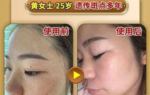 氢醌霜祛斑的危害(氢醌霜祛斑的危害有哪些)