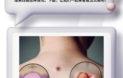 背部长痘痘是什么原因造成(男生后背长痘是梅毒吗)