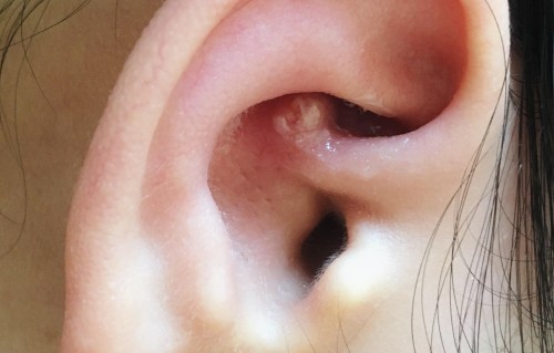 耳朵里面长痘痘(耳朵里面长痘痘的图片)