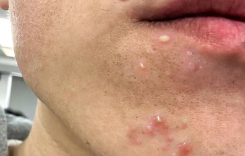 下巴长痘痘(下巴长痘痘是因为什么原因引起的)