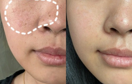 怎么祛斑(怎么祛斑彻底又不反弹)