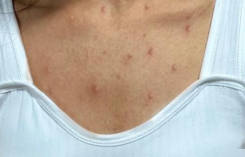 胸口长痘痘是什么原因(男人胸口长痘痘是什么原因)