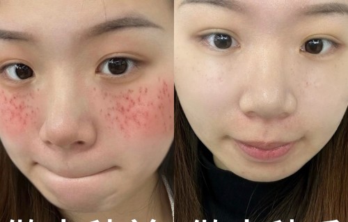 做皮秒祛斑多少钱一次(皮秒祛斑多少钱一次鹤岗)