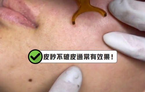 激光祛斑有什么危害(激光祛斑对身体有影响吗)