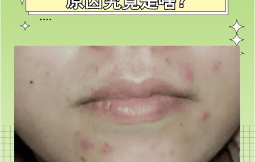 眉心长痘痘什么原因(眉毛长痘痘什么原因引起的)