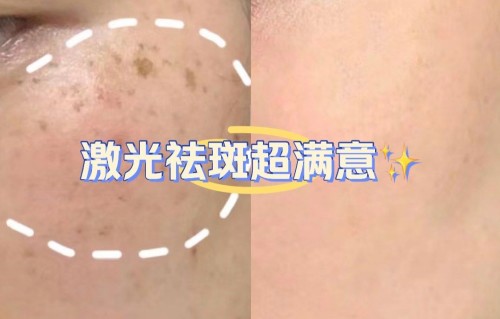 激光祛斑容易反弹吗(激光祛斑会不会反弹?)