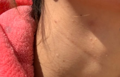 脖子长痘痘(脖子长痘痘用什么药膏)