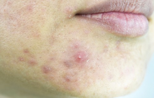 痘痘图片(痘痘图片前后对比)