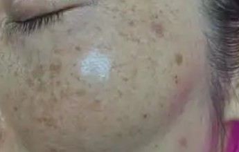 镭射祛斑效果及副作用(镭射祛斑效果及副作用图片)